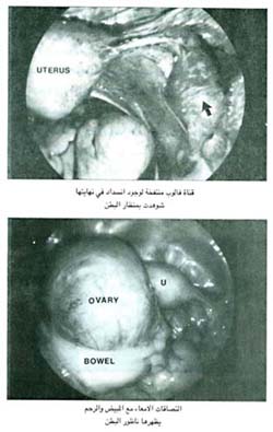 قناة فالوب منتفخة لوجود انسداد في نهايتها شوهدت بمنظار البطن / التصاقات الامعاء مع المبيض والرحم يظهرها ناظور البطن